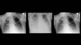 Adevăratele consecințe pe termen lung ale infecției cu coronavirus: ce se întâmplă cu plămânii